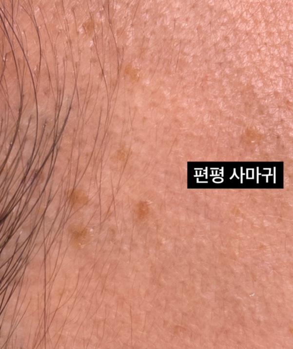 편평사마귀 제거 쥐젖 차이 : 네이버 블로그