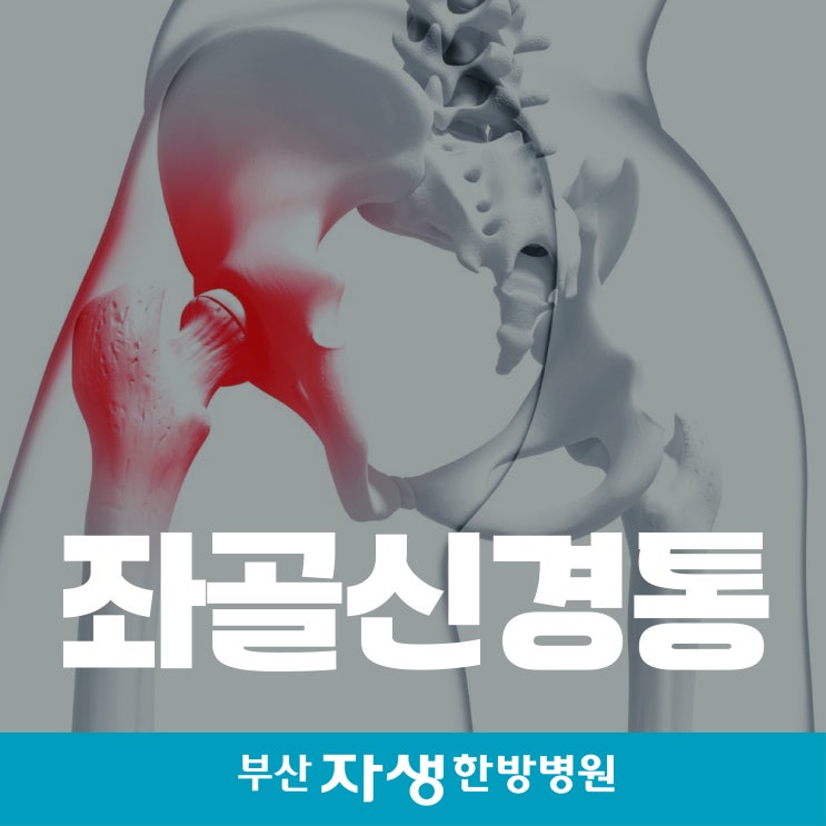 부산 좌골신경통이란? 원인과 증상완화 스트레칭 : 네이버 블로그