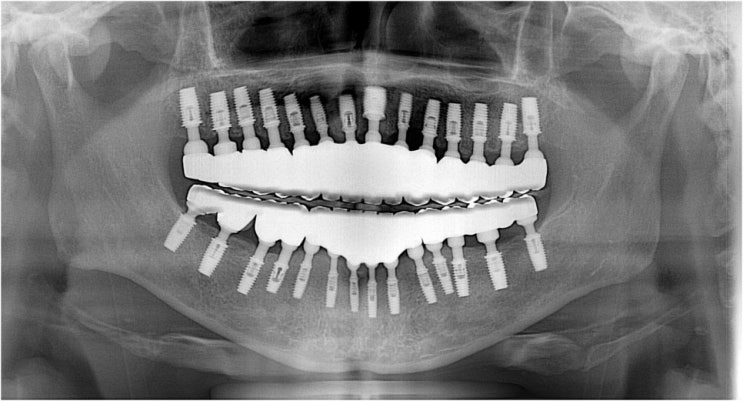 안산한국치과병원의 에스락임플란트 SLOCK IMPALANT : 네이버 블로그