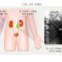 신장결석의 진단 및 검사란? 세번째 이야기입니다.