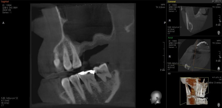 3wks F/U with CT : Post Excelos Inject : 네이버 블로그