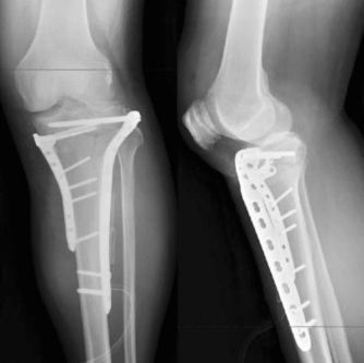 [정형외과 전문의] 근위 경골 골절 수술 (ORIF of proximal tibia fracture) : 네이버 블로그