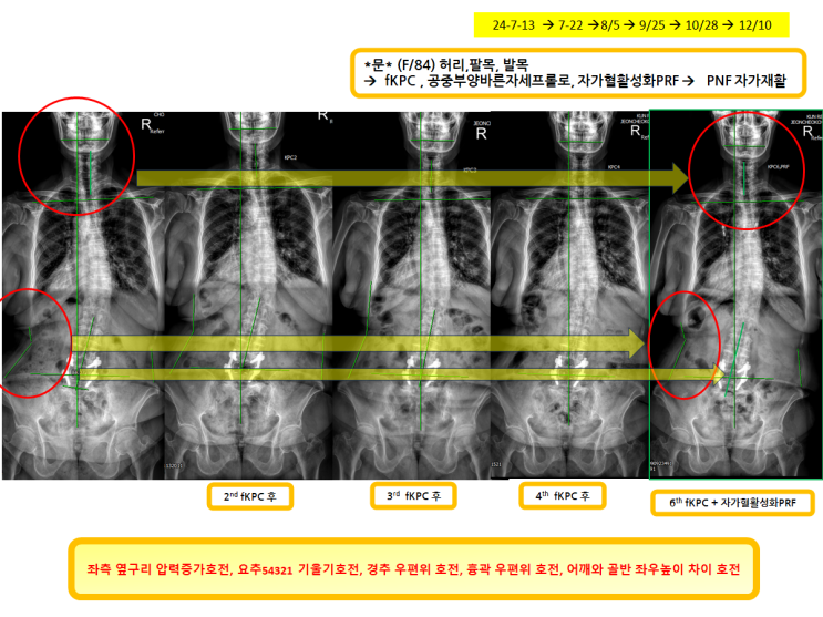 6번째 녹는실 KPC 치료받으신 분!! : 네이버 블로그