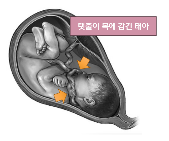태아의 목에 탯줄이 감겨있대요? 괜찮나요?😮 : 네이버 블로그