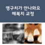 영구치가 안나와요 (매복치, 악궁확장장치, 인비절라인 교정)