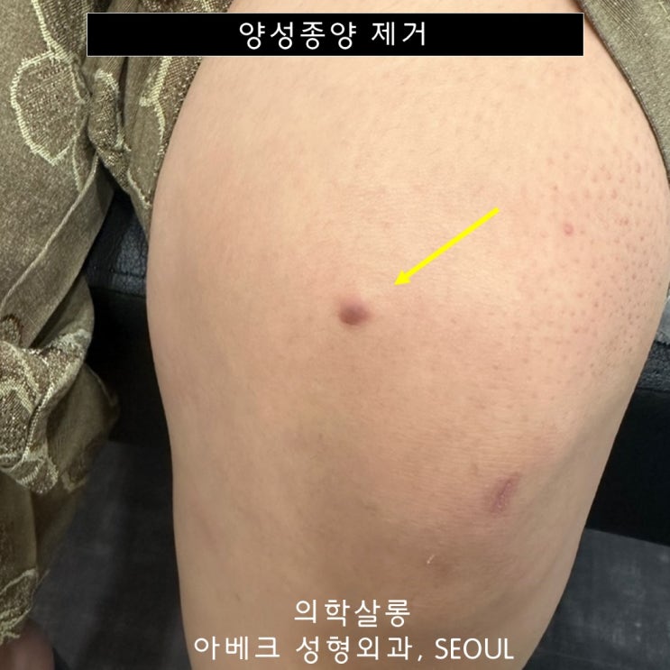 무릎 검고 딱딱한 피부 혹 , 무릎 피부섬유종 제거 후기기 【Dr. 아베크 양성종양】 : 네이버 블로그