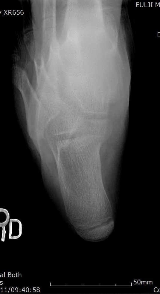 종골 촬영 (Calcaneus) : 네이버 블로그