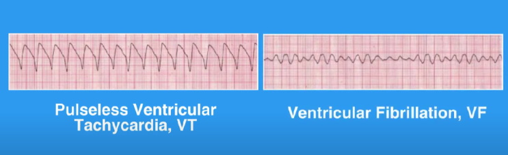 CPR , Defibrillation 제세동, Ventricular fibrillation &Pulseless ...