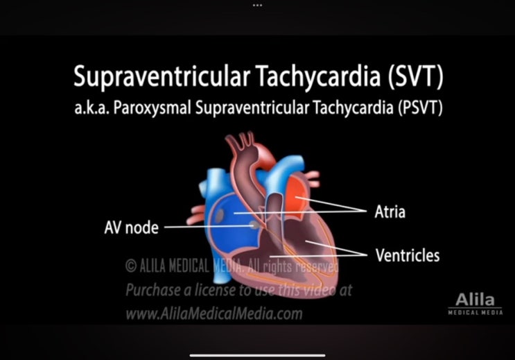 의학용어 PSVT, SVT 차이 공부하기, 전극도자절제술 (Atrial Ablation) : 네이버 블로그