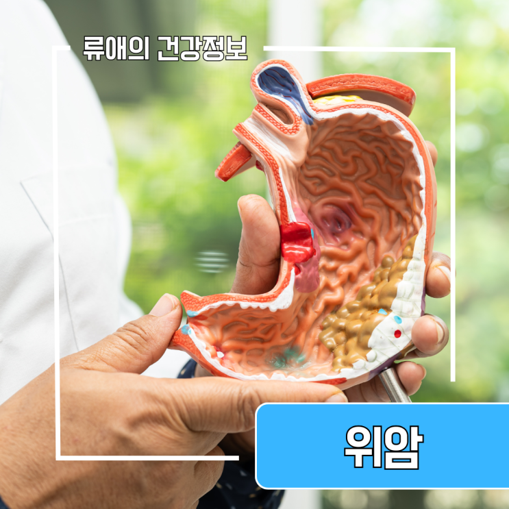 위암초기증상 및 원인 20대 위암 증상 : 위암 전이 증상 : 네이버 블로그