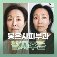 봉은사피부과 팔자주름, 필러? 리프팅? 나에게 맞는 시술은