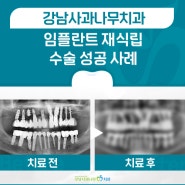 강남사과나무치과, 임플란트수술 후회하는 분들께 드리는 말씀