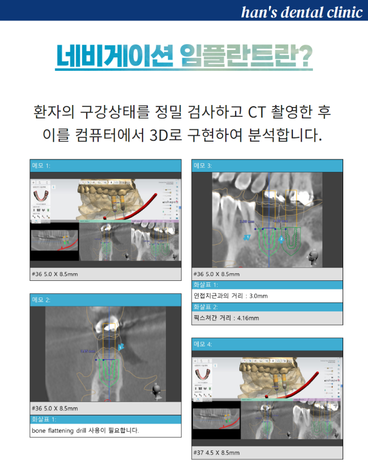 원가이드 (Osstem One-guide system) 네비게이션 임플란트 : 네이버 블로그
