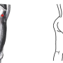 대퇴근막장근(Tensor fascia latae)