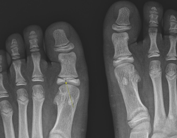 위례리본정형외과: 소아 엄지발가락 성장판 틈( epiphyseal cleft) : 네이버 블로그