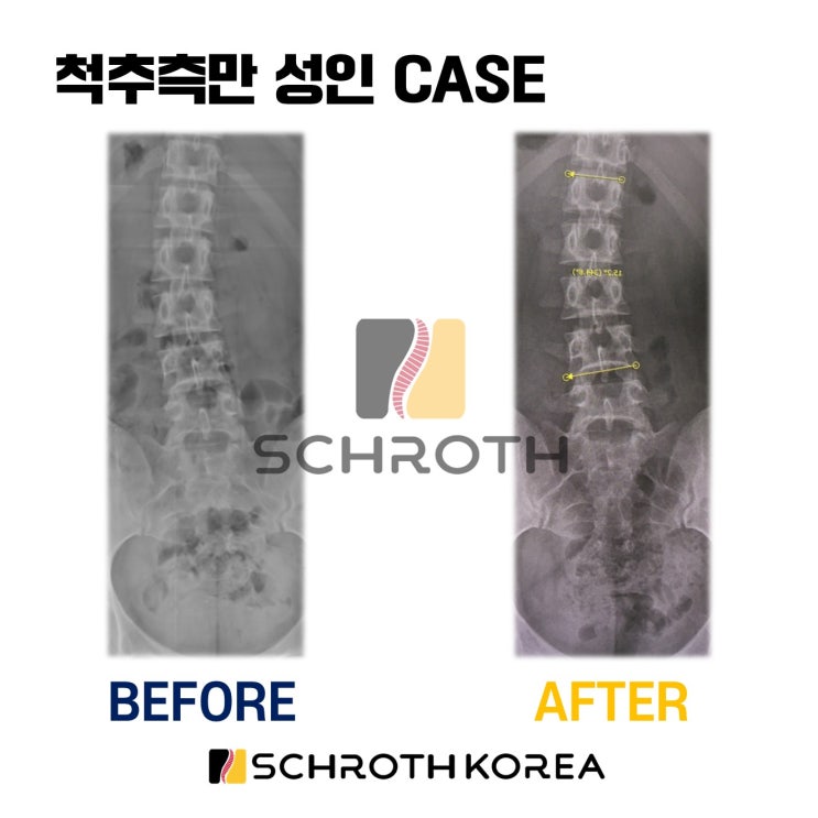 20대 성인 척추측만 슈로스 운동 요추 25도 15도 척추측만증교정 육군사관학교 합격후기 : 네이버 블로그