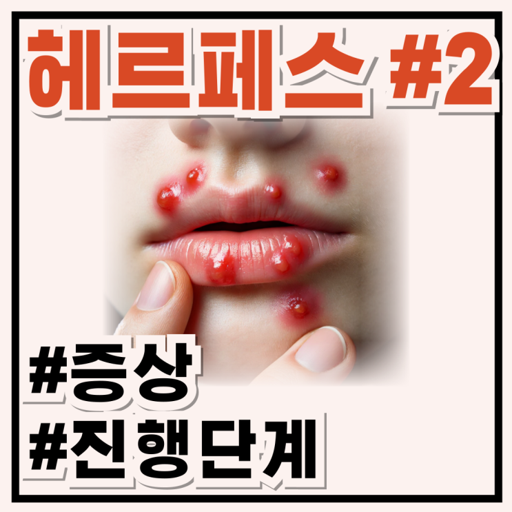 입술 포진 헤르페스, 초기증상과 진행 단계 자세히 알아보기 : 네이버 블로그