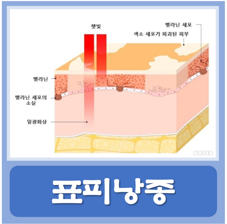 표피낭종 제거 보험 수술비 원인 병원 피부과 외과 : 네이버 블로그