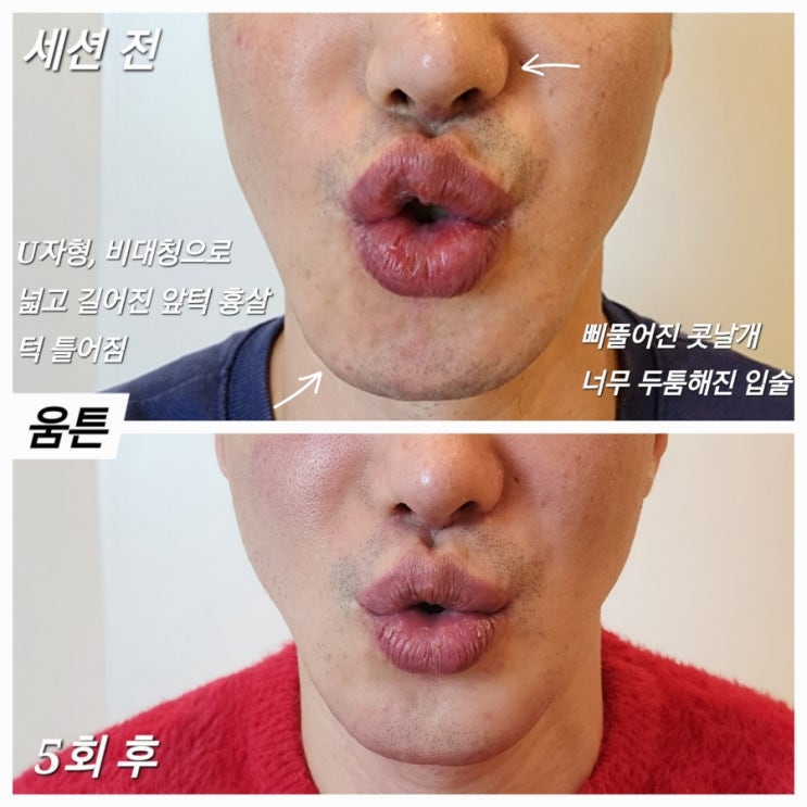인중축소와 앞턱 흉살 때문에 넓어진 하관 부작용 : 네이버 블로그