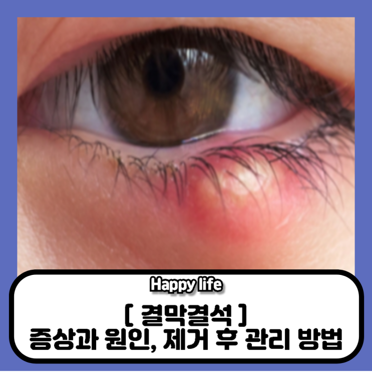 결막결석 후기, 제거 후 관리, 재발 가능성 : 네이버 블로그