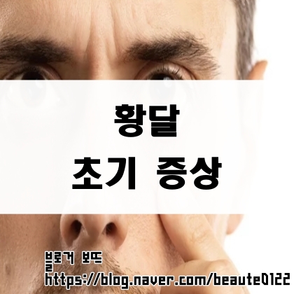 황달 초기 증상 손바닥 눈흰자 노란 원인 : 네이버 블로그