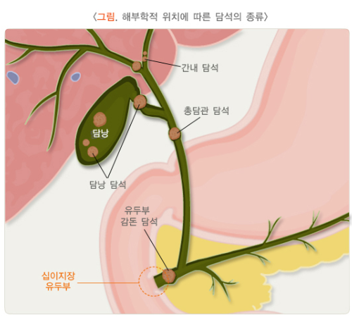 [담도 결석과 염증_ 병태생리, 종류] : 네이버 블로그