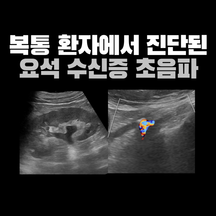 복통으로 내원하여 진단된 요석 수신증 [광진구 복부초음파] : 네이버 블로그