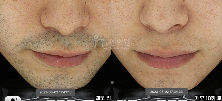 남자 레이저 제모 (턱수염 제모) : 네이버 블로그