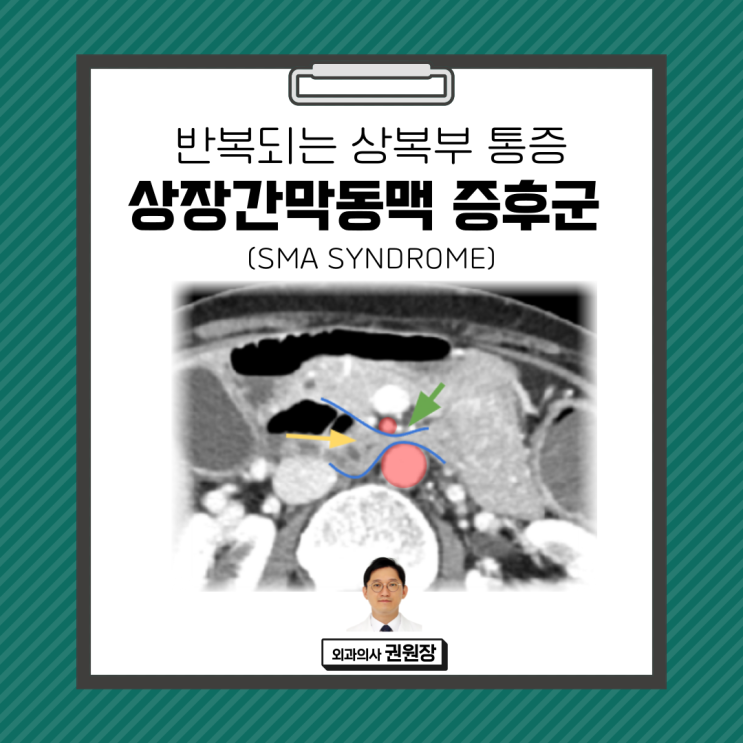 반복되는 상복부 통증. 상장간막동맥 증후군 (SMA syndrome, Wilkie syndrome)이 의심된 경우. : 네이버 블로그