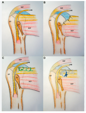 회전근개파열 수술 ; 이두근건 재배치, 견갑하건 봉합 ;Biceps Rerouting, Subscapularis(SSC ...
