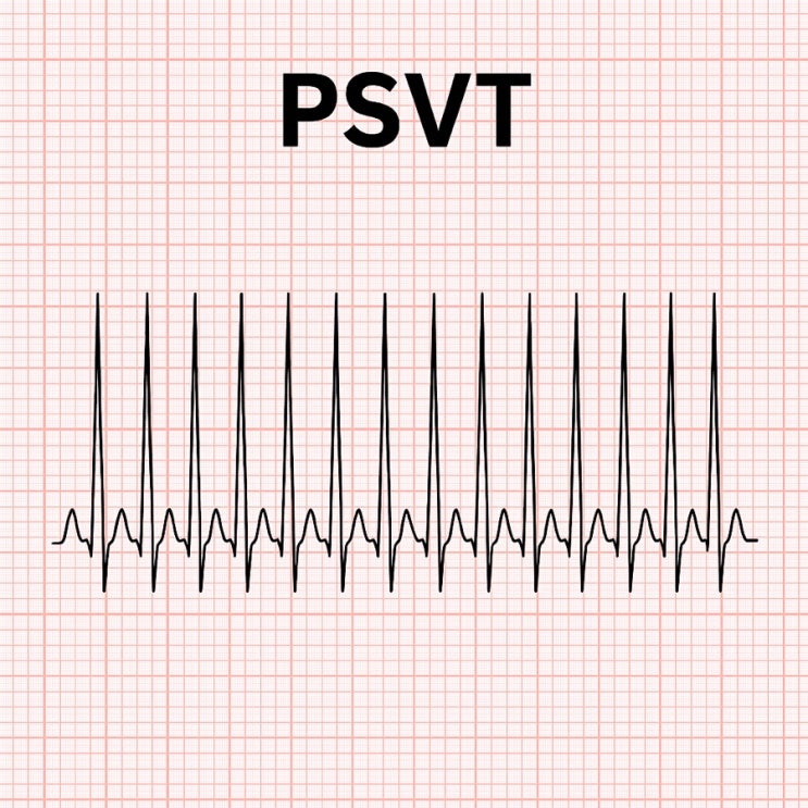 PSVT(발작성심실상성빈맥)란? 정의, EKG, 증상, 진단, 약물치료, 시술, 간호 : 네이버 블로그