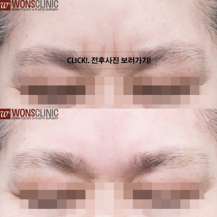 미간 주름, 수원미간필러로 자연스럽게 개선하세요. 전후사진 보러라기 2025_0-19 인계동 원스의원 : 네이버 블로그