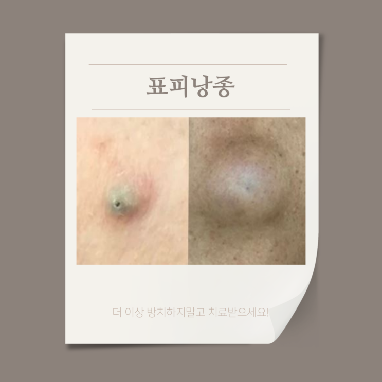 귓볼 표피낭종 외과적 수술로 주머니까지 제거 : 네이버 블로그