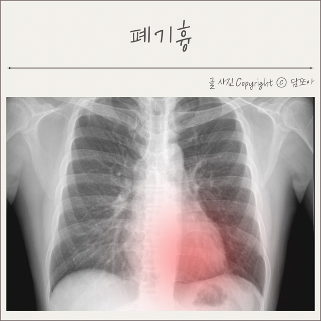 기흉 증상 폐기흉 원인 치료법 : 네이버 블로그