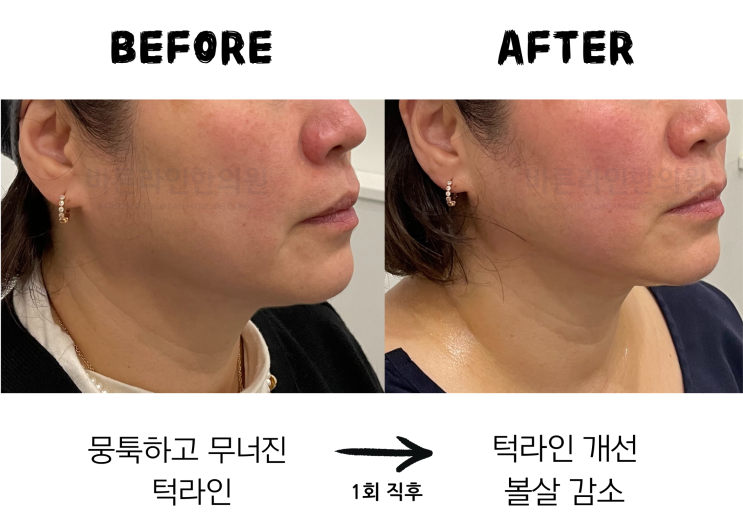 맥스웨이브 리프팅 - 극초단파로 피부 깊숙히. V라인 만들기! : 네이버 블로그