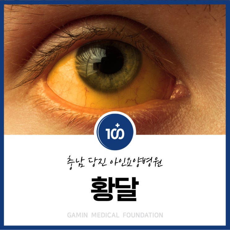 황달 원인 질환, 간 췌장 당뇨 기능 이상을 알리는 중요한 신호 | 충남 당진 요양병원 아인요양병원 : 네이버 블로그