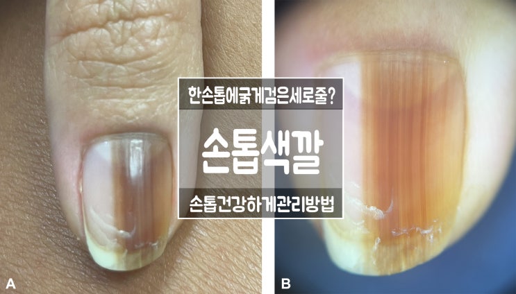 손톱 검은 세로 줄 원인 손톱에 색깔 흰 점 갈색 푸른색 보라색 노란색 건강 신호 등 갈라짐 관리 : 네이버 블로그