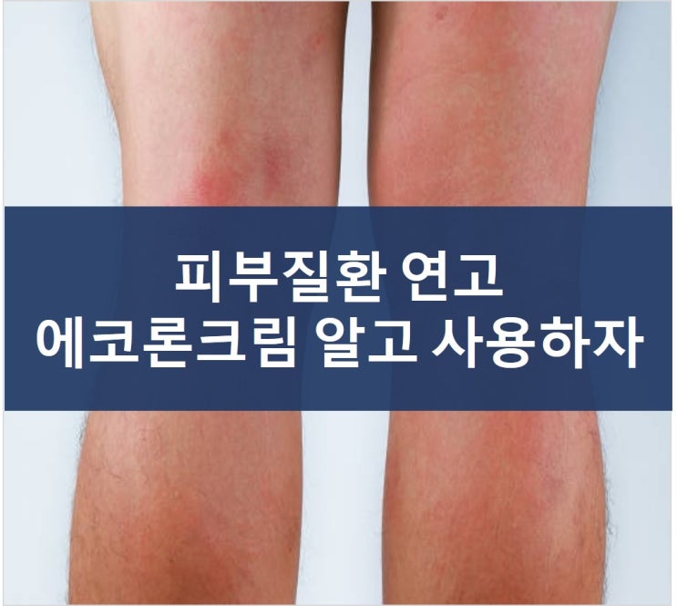 에코론 크림(무좀, 완선, 피부칸디다증) 피부질환 연고 제대로 알고 사용하자 : 네이버 블로그