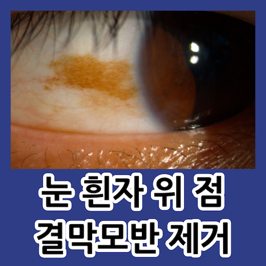 눈 흰자 점 결막모반 제거 강남안과 선택 기준 : 네이버 블로그