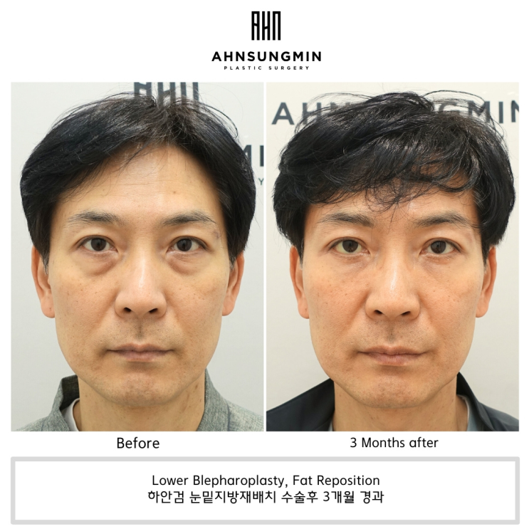 하안검 눈밑지방재배치 수술 전과 후 비교 사례 살펴보기 : 네이버 블로그