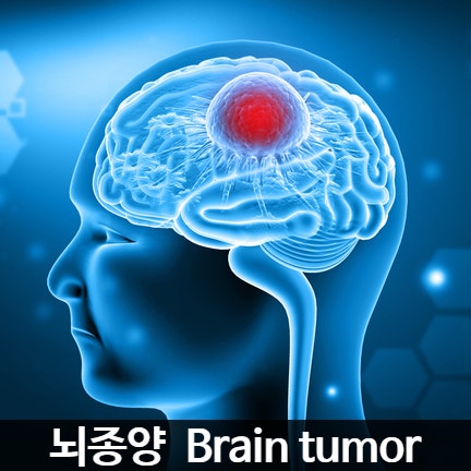 뇌종양 초기증상, 뇌종양 위치·뇌종양 크기에 따라 뇌종양 항암 바뀌나? : 네이버 블로그