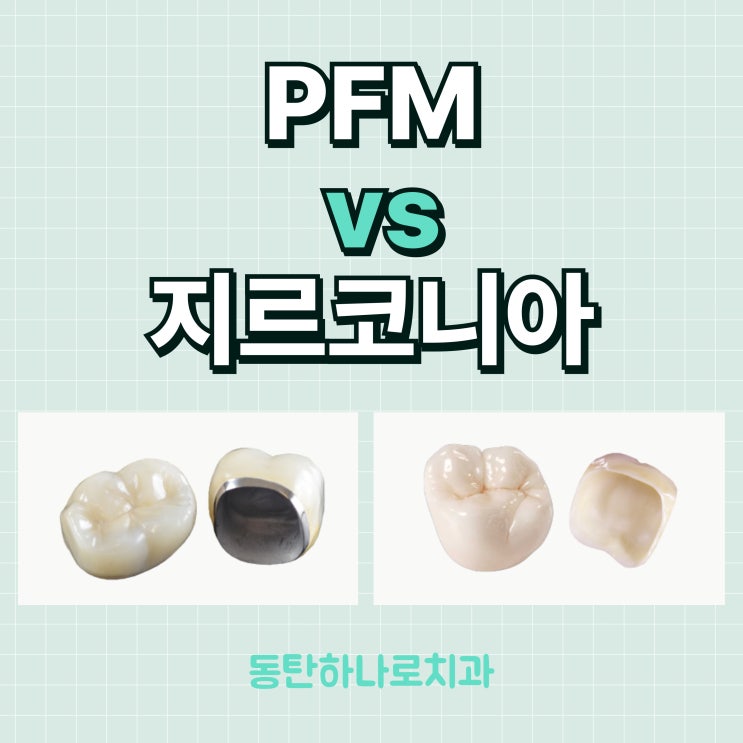 PFM 지르코니아 차이, 나에게 맞는 보철은 무엇일까? : 네이버 블로그