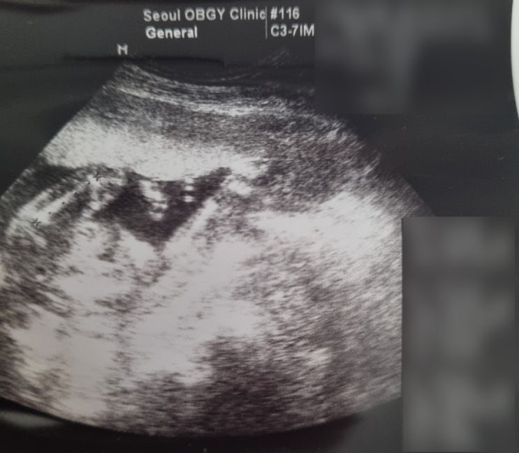 [임신 19주] 임산부 대게 알러지 응급실 / 산부인과 방문 썰 : 네이버 블로그