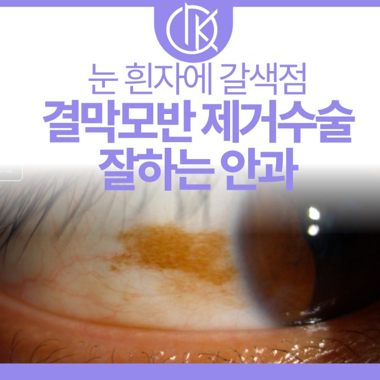 눈 흰자에 갈색점, 결막모반 제거수술 잘하는곳 신논현역안과 추천 : 네이버 블로그