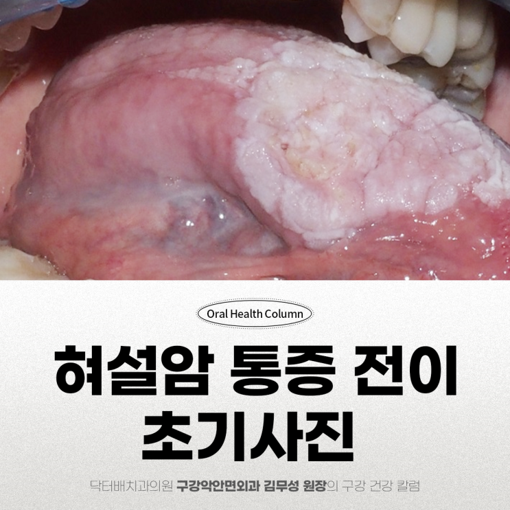 정미애 혀 설암, 초기증상 사진 통증 전이 : 네이버 블로그