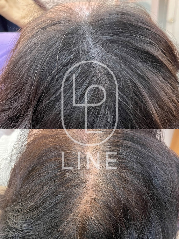 분당/서현/성남/수내 가르마탈모커버 라인LINE 두피 SMP : 네이버 블로그