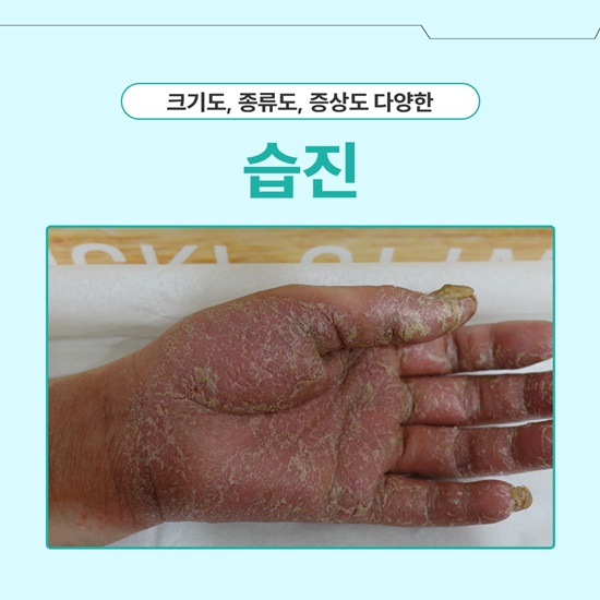 분당 습진 증상 개선해보아요 : 네이버 블로그