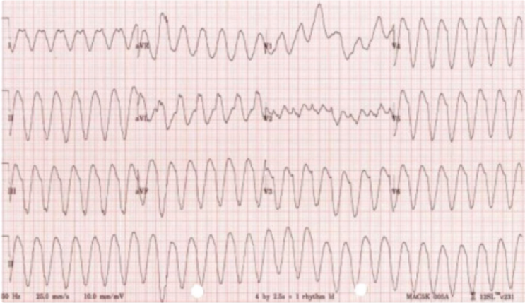 동기화 심율동전환(Synchronized Cardioversion)과 비동기화 제세동(Unsynchronized ...