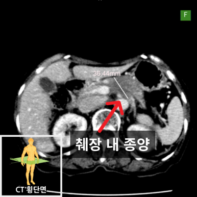 췌장암 검사방법, 복부CT, 췌장MRI : 네이버 블로그