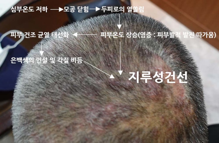지루성건선(Sebopsoriasis) - 원인, 증상, 발생기전, 치료법 : 네이버 블로그